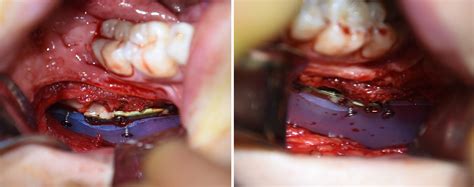 It is the only movable bone of the skull (discounting the ossicles of the middle ear). Plastic Surgery Case Study - Jaw Angle Implants after ...