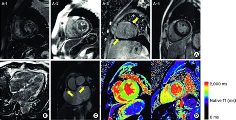 Cardiovascular Magnetic Resonance Cmr Images Of Cardiac Amyloidosis