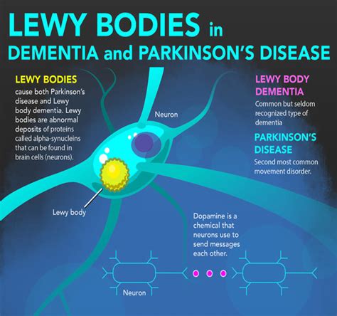Lewy Bodies In Dementia And Parkinsons