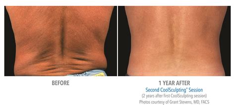 Coolsculpting Knees Before And After Photos