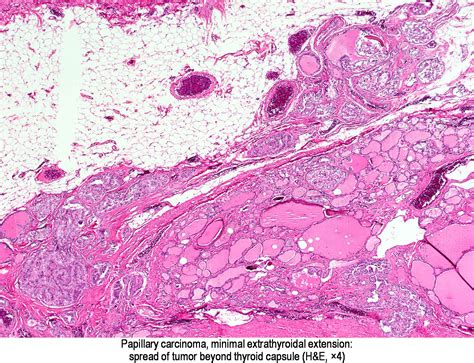 Epithelial mesothelioma is the most common cell type of the cancer. Pathology Outlines - Papillary carcinoma - general