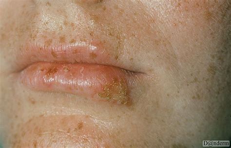 Cold sores start like this one with vesicles. 8-67-1 Herpes simplex