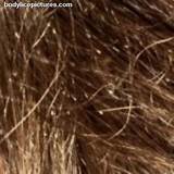 Lice Eggs After Treatment Pictures