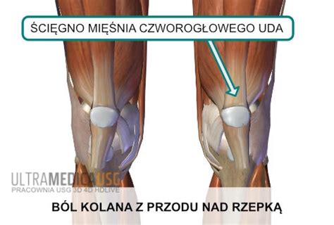 Ból kolan przyczyny bólu kolan Blog ULTRAMEDICA