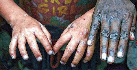 Massive Skin Disease Affected Many Villagers At Raninagar Due To Panga