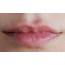 Juvederm Lip Filler  Smile Gallery Cook Family And Cosmetic Dentistry