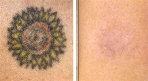 Tattoo verwijderen bij huidkliniek de vliet. Tatoeage verwijderen in Breda | Het Lasercentrum | Dé specialist
