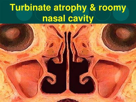 In this article, we shall look at the applied anatomy of the nasal cavity, and some of the relevant clinical syndromes. PPT - Infective & Atrophic Rhinitis PowerPoint ...