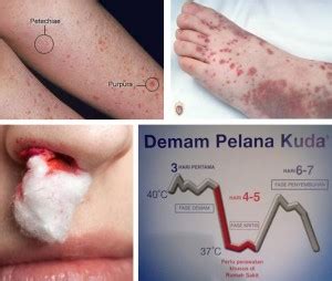Langkah Pencegahan Penyakit DBD dan Seputar Pengobatannya