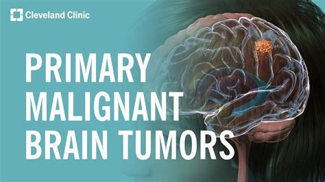 What Are Primary Malignant Brain Tumors? - YouTube