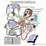 Photos of Medical Treatment For Pulmonary Embolism