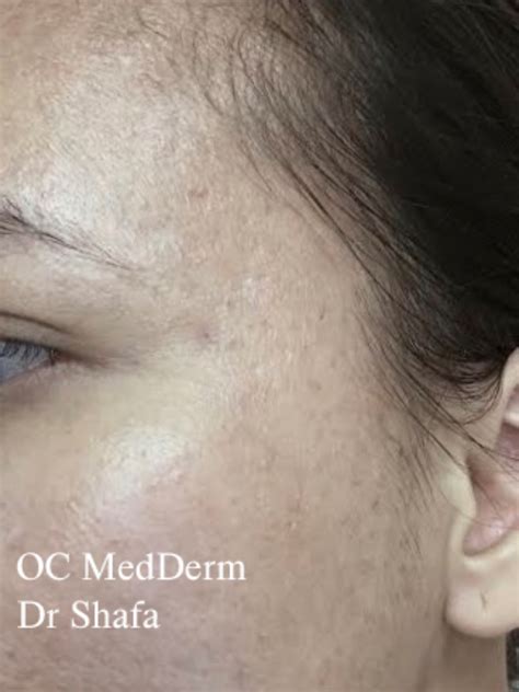 Bumps On Face And Neck Gallery Oc Medderm Irvine Dermatology
