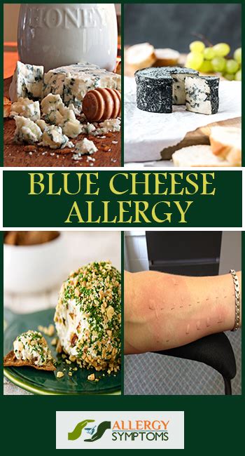 Blue Cheese Allergy Allergy Symptoms