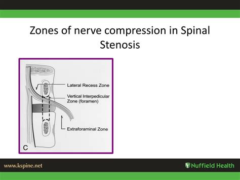 This pain occurs when the spinal canal begins shrinking. PPT - Lumbar canal stenosis PowerPoint Presentation, free ...