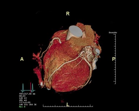 Heart CT Scan In London | Heart Health | Echelon Health