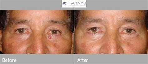 Eyelid Skin Cancer Before And After Photos Taban Md