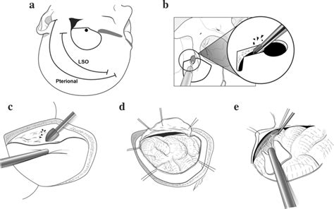 Step By Step Procedures Of A Left Lateral Supraorbital Lso Approach