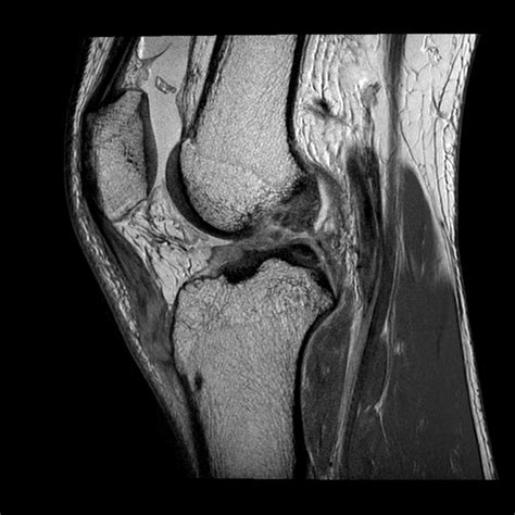 Segond fracture with anterior cruciate ligament and ...
