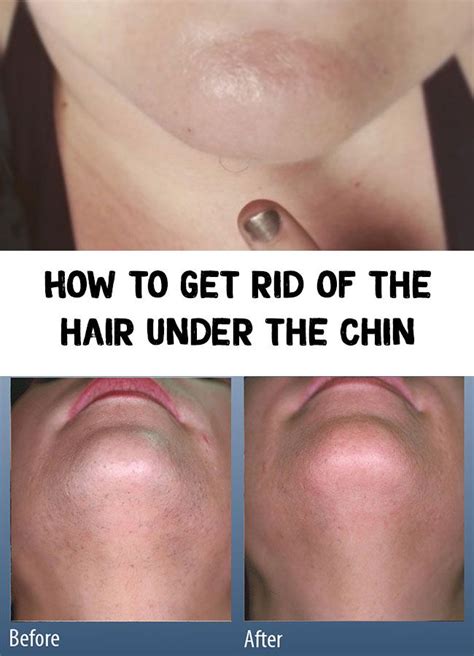 How To Get Rid Of The Hair Under The Chin Chin Hair Chin Hair