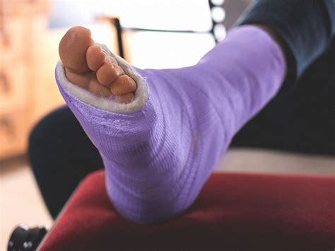 Broken Foot Symptoms What To Expect