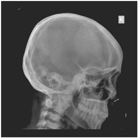 Radiograph Skull Lateral View Revealed The Incidental Finding Of