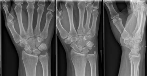 Fractures Of The Carpal Bones Clinics In Plastic Surgery