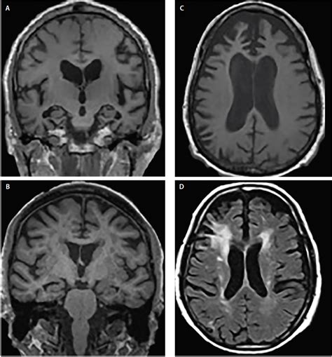 Brain Imaging In Differential Diagnosis Of Dementia Practical Neurology