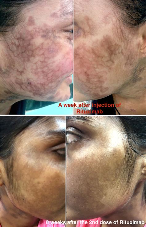 Reticulate Pigmentation Erythematous To Brown Reticulate Pigmentation
