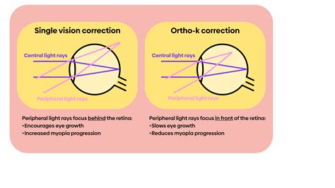 Ortho K For Myopia Control My Kids Vision