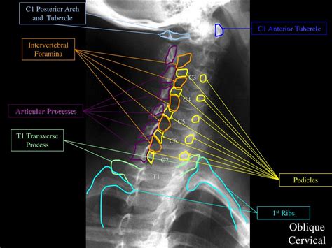 Ppt Normal Radiographic Spinal Anatomy Powerpoint Presentation Free