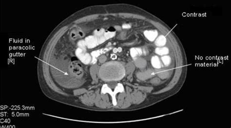 Ct Abdomen And Pelvis With Oral Contrast Cpt Hot Sex Picture