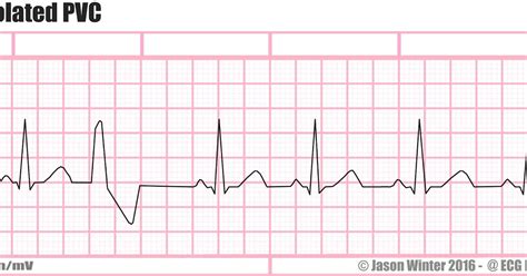 Ecg Educator Blog Premature Ventricular Contraction Pvc