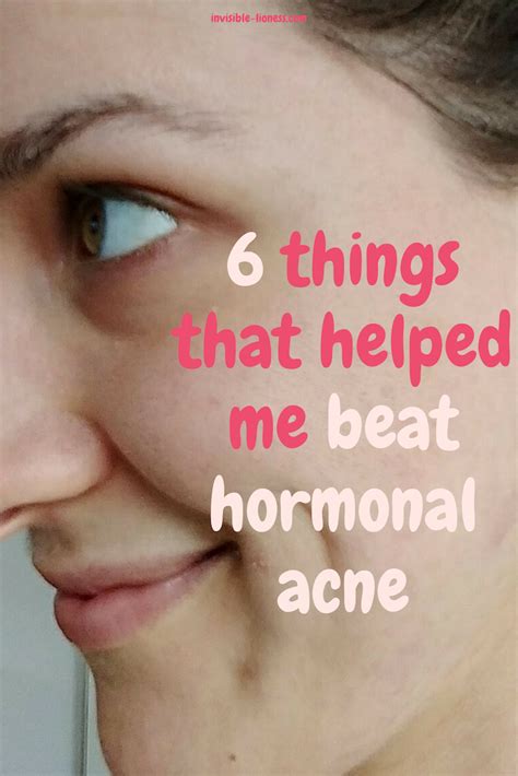 For acne related to your menstrual cycle, there are three main hormones at play: I beat hormonal acne: My 6 powerful little secrets ...