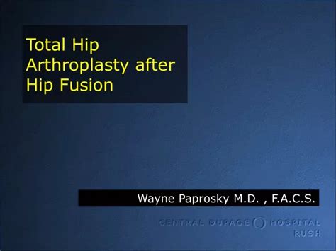 Ppt Total Hip Arthroplasty After Hip Fusion Powerpoint Presentation