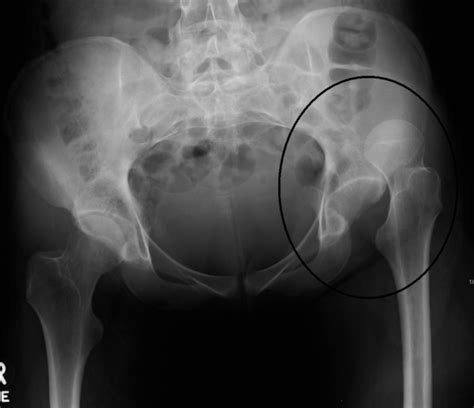 Hip Dislocation Physiopedia