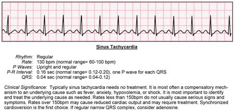 Svt Ekg Strip