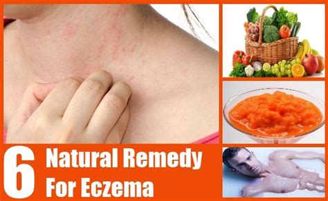 6 Natural Remedy For Eczema Natural Eczema Remedies Eczema Remedies Natural Remedies