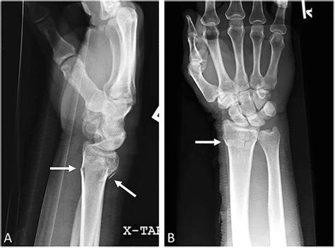 Colles Fracture Lateral A And Ap B Wrist Radiographs Transverse