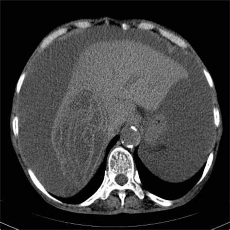 Hepatic Hydatid Cyst With Biliary Tree Communication And Simultaneous