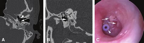 Myringosclerosis In A 63 Year Old Woman With Constant Left Ear Pain And