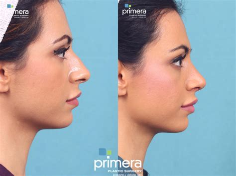 Rhinoplasty Before And After Pictures Case 421 Orlando Florida