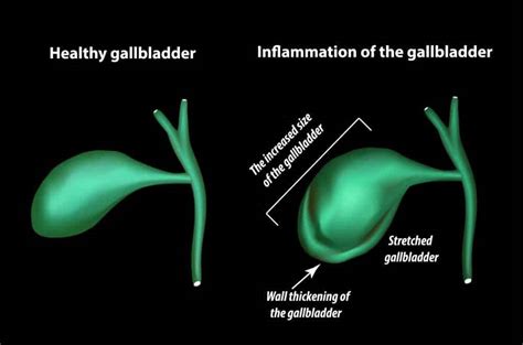 11 Warning Signs Of Gallbladder Cancer You Should Not Ignore
