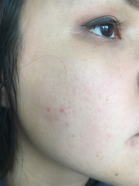 Closed Comedones Or Papules On Cheeks How To Make Them Go Away Acne