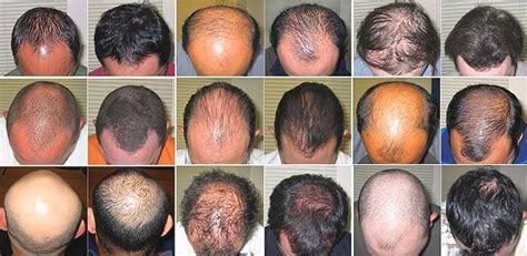 Types Of Hair Loss With Causes And Treatment At Home