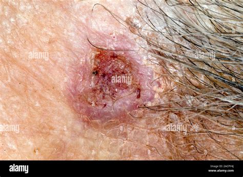 Close Up Of A Basal Cell Carcinoma Bcc Or Rodent Ulcer On The