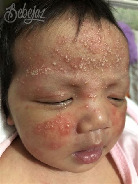 Blog My 2nd Baby Had Cradle Cap Seborrheic Dermatitis In Infants