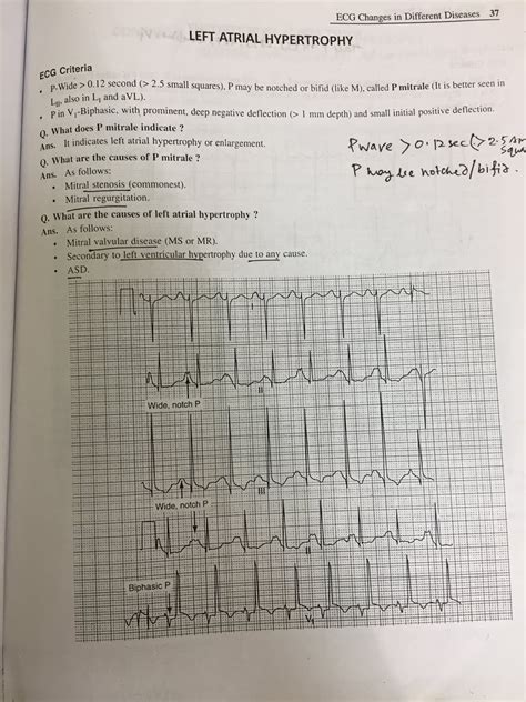 E C G Biventricular Hypertrophy And Left Atrial Hypertrophy