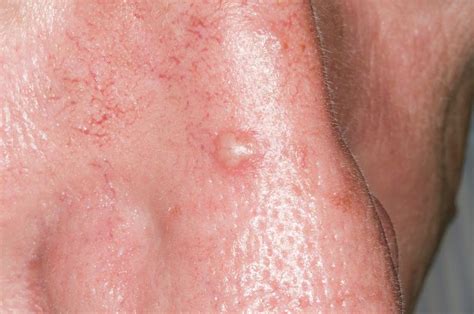 Skin Cancer On Face Stages