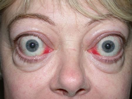 My nose inflamed with red led lights (i got a small bulb of red led light emitting Orbital inflammation