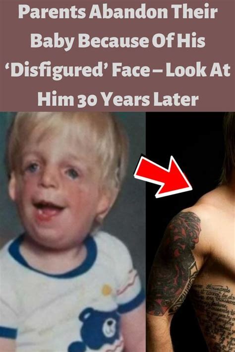Parents Abandon Their Baby Because Of His Disfigured Face Look At